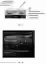Fig. 02 - Intra-needle ultrasound system and its method of use for analysis, tracking, and display of pleura in millimeter scale resolution