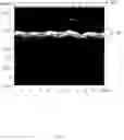 Fig. 06 - Intra-needle ultrasound system and its method of use for analysis, tracking, and display of pleura in millimeter scale resolution