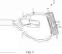 Fig. 02 - Hybrid Suture Anchor
