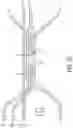 Fig. 06 - Locking suture construct