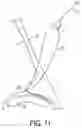 Fig. 18 - Locking suture construct