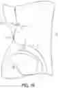 Fig. 26 - Locking suture construct