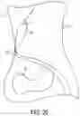Fig. 27 - Locking suture construct