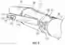 Fig. 05 - Suturing devices and methods for suturing an opening in the apex of the heart
