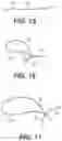 Fig. 07 - System And Method For All-Inside Suture Fixation For Implant Attachment And Soft Tissue Repair