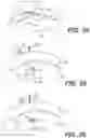 Fig. 14 - System And Method For All-Inside Suture Fixation For Implant Attachment And Soft Tissue Repair