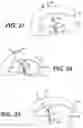 Fig. 15 - System And Method For All-Inside Suture Fixation For Implant Attachment And Soft Tissue Repair