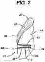 Fig. 03 - Knotless suture anchor with unthreaded nose