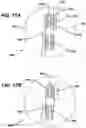 Fig. 16 - Knotless suture anchor with unthreaded nose