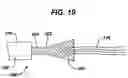 Fig. 19 - Knotless suture anchor with unthreaded nose
