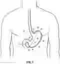 Fig. 02 - END EFFECTORS, SURGICAL STAPLING DEVICES, AND METHODS OF USING SAME