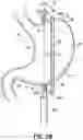 Fig. 04 - END EFFECTORS, SURGICAL STAPLING DEVICES, AND METHODS OF USING SAME