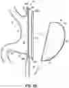Fig. 06 - END EFFECTORS, SURGICAL STAPLING DEVICES, AND METHODS OF USING SAME