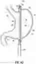 Fig. 43 - END EFFECTORS, SURGICAL STAPLING DEVICES, AND METHODS OF USING SAME