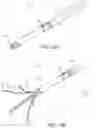 Fig. 21 - Clipping device for large defects, perforations and fistulas