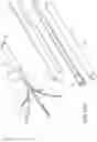 Fig. 24 - Clipping device for large defects, perforations and fistulas