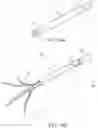 Fig. 25 - Clipping device for large defects, perforations and fistulas