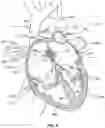 Fig. 06 - Cardiac shunt device and delivery system