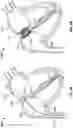 Fig. 09 - Cardiac shunt device and delivery system