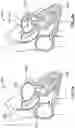 Fig. 11 - Cardiac shunt device and delivery system
