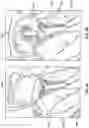 Fig. 12 - Cardiac shunt device and delivery system