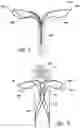 Fig. 03 - Aneurysm devices with additional anchoring mechanisms and associated systems and methods