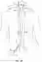 Fig. 02 - Devices and methods using percutaneous transjugular carotid flow reversal