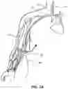 Fig. 03 - Devices and methods using percutaneous transjugular carotid flow reversal