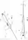Fig. 04 - Devices and methods using percutaneous transjugular carotid flow reversal