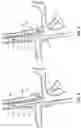 Fig. 11 - Devices and methods using percutaneous transjugular carotid flow reversal