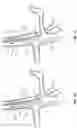 Fig. 12 - Devices and methods using percutaneous transjugular carotid flow reversal