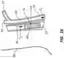 Fig. 15 - Devices and methods using percutaneous transjugular carotid flow reversal