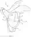 Fig. 03 - Method of using a combination driver/anti-rotation handle for shoulder arthroplasty