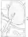 Fig. 08 - METHODS AND DEVICES FOR TREATING STROKE
