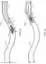 Fig. 05 - Apparatus, system, and method for vasculature obstruction removal