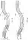 Fig. 07 - Apparatus, system, and method for vasculature obstruction removal