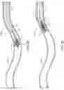 Fig. 08 - Apparatus, system, and method for vasculature obstruction removal