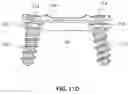 Fig. 13 - Implantable vertebral frame systems and related methods for spinal repair