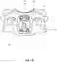 Fig. 54 - Implantable vertebral frame systems and related methods for spinal repair