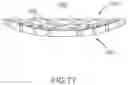 Fig. 57 - Device and method for reinforcement of a facet