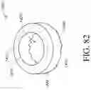 Fig. 62 - Device and method for reinforcement of a facet