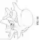 Fig. 64 - Device and method for reinforcement of a facet