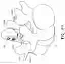 Fig. 69 - Device and method for reinforcement of a facet