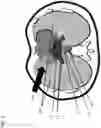 Fig. 02 - APPARATUS, SYSTEMS, AND METHODS FOR OPTIMIZING DELIVERY OF RADIATION TO TREAT CARDIAC ARRHYTHMIAS