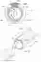 Fig. 30 - Apparatus, systems, and methods for achieving intravascular, thermally-induced renal neuromodulation related application