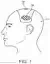 Fig. 02 - SYSTEM FOR ENDOSCOPIC INTRACRANIAL PROCEDURES