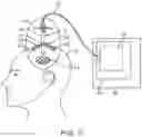 Fig. 03 - SYSTEM FOR ENDOSCOPIC INTRACRANIAL PROCEDURES