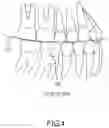 Fig. 07 - System and method for positioning three-dimensional brackets on teeth