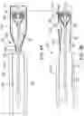 Fig. 08 - Endoluminal device