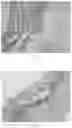 Fig. 04 - IMPLANTABLE DEVICE